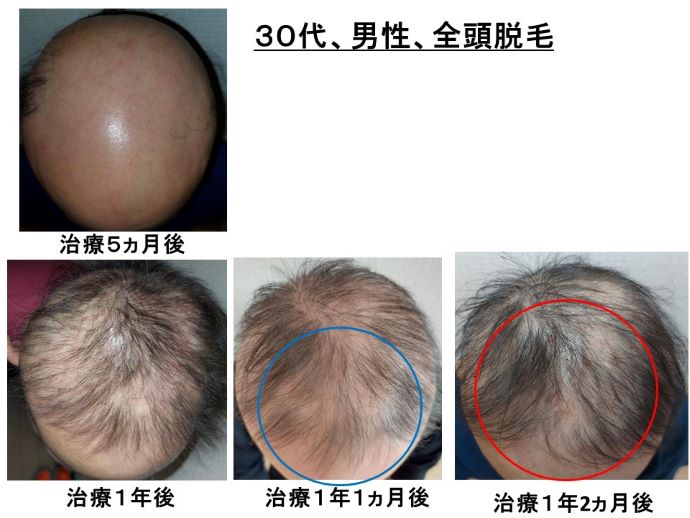 円形脱毛症　病院